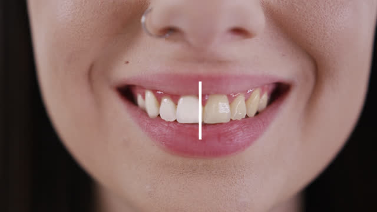 The Future of Dental Aesthetics: Insights Regarding OEM Teeth Whitening Strips